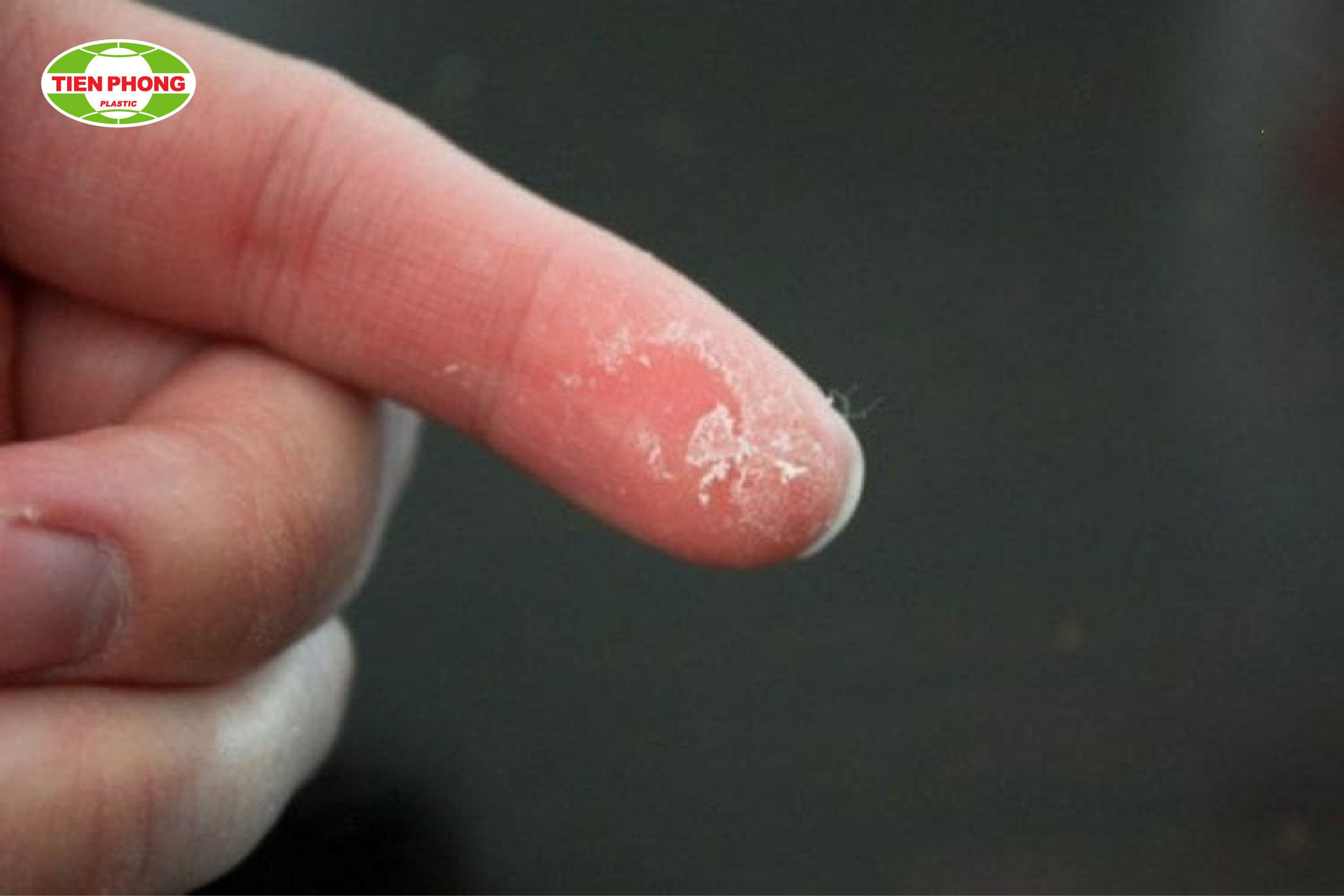 Vết keo dán ống nhựa PVC cứng đầu dính trên tay, cần được xử lý nhanh chóng để tránh khó chịu và tổn thương da.